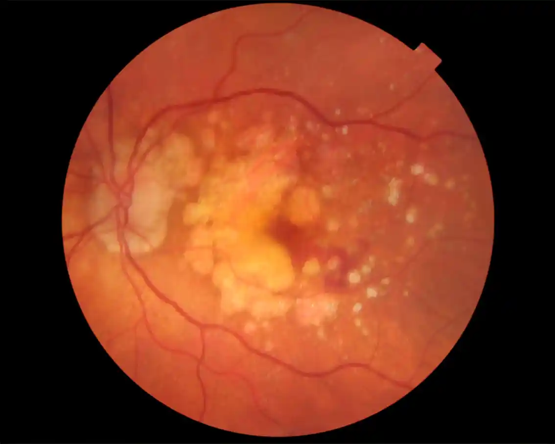 amdbristolretinaophthalmologistsidathliyanage 1.webp