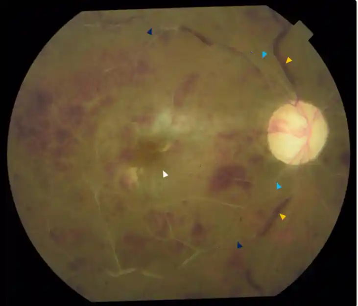 eye aaaaa